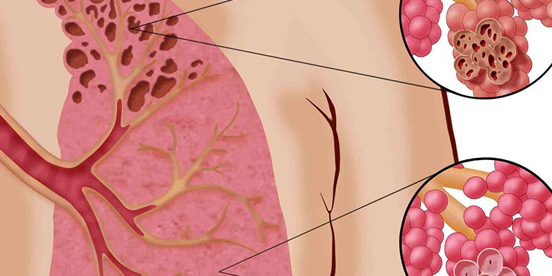 رادیوتراپی استریوتاکتیک برای درمان سرطان ریه