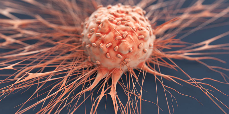 درمان سرطان روده بزرگ با رادیوتراپی