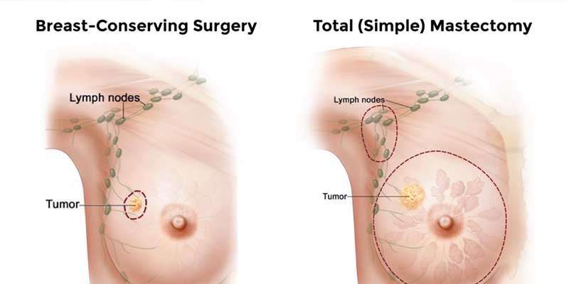 متخصص سرطان سینه در تهران | دکتر مسعود جمالی