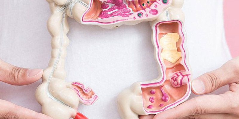 بهترین دکتر سرطان روده بزرگ در تهران